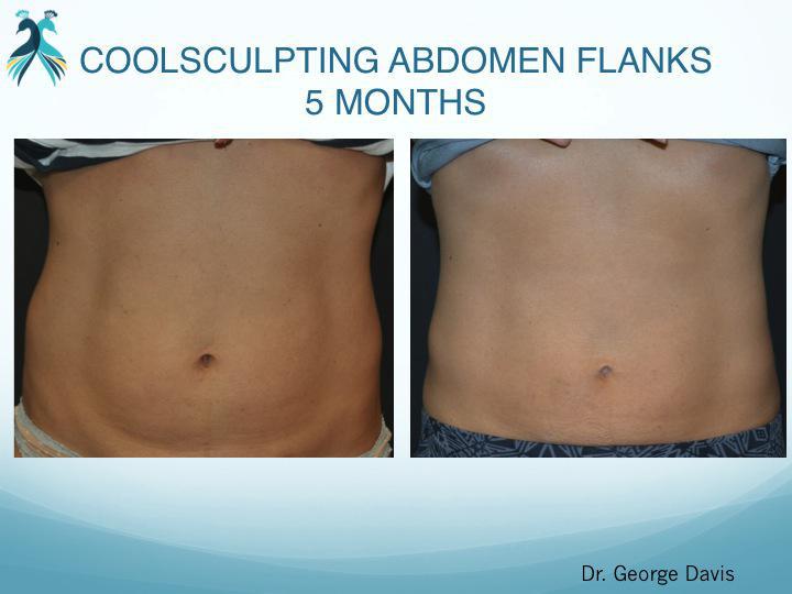 Coolsculpting Elite, LA Beauty Skin Center