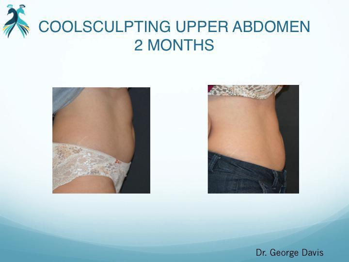 Coolsculpting Results Before and After in Woodlands TX