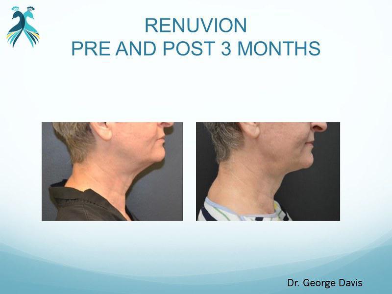 Renuvion for Skin Tightening in Houston, TX in Houston, Katy