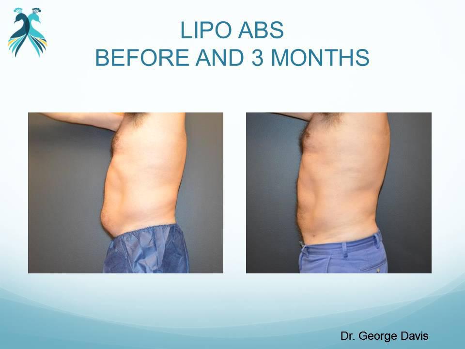 Mini Lipo - Mini Liposuction in Woodlands TX