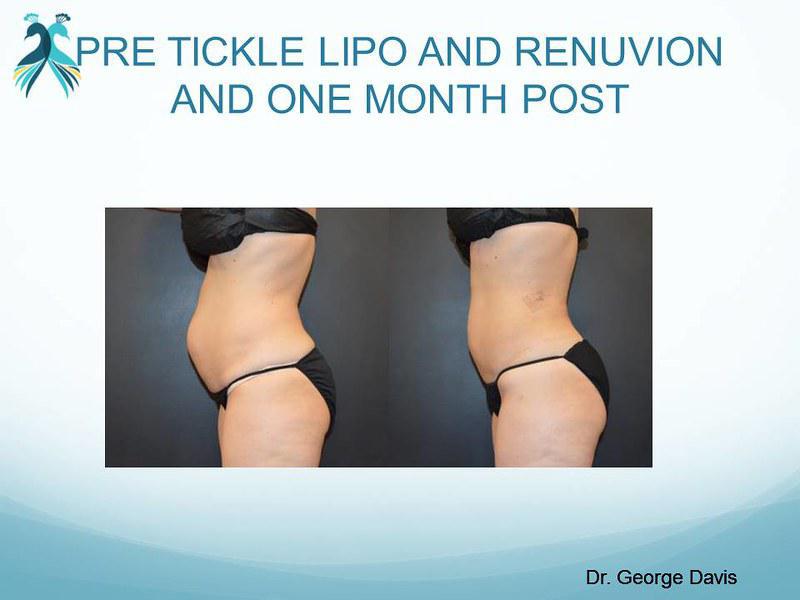 Liposuction in Woodlands TX | Tickle Lipo 