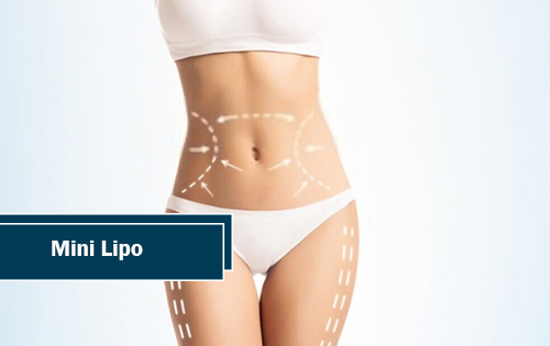 Liposuction with Tickle Lipo | Conroe, TX