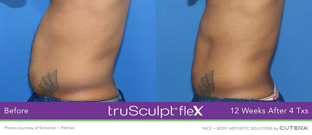 Muscle Sculpting with TruSculpt Woodlands TX