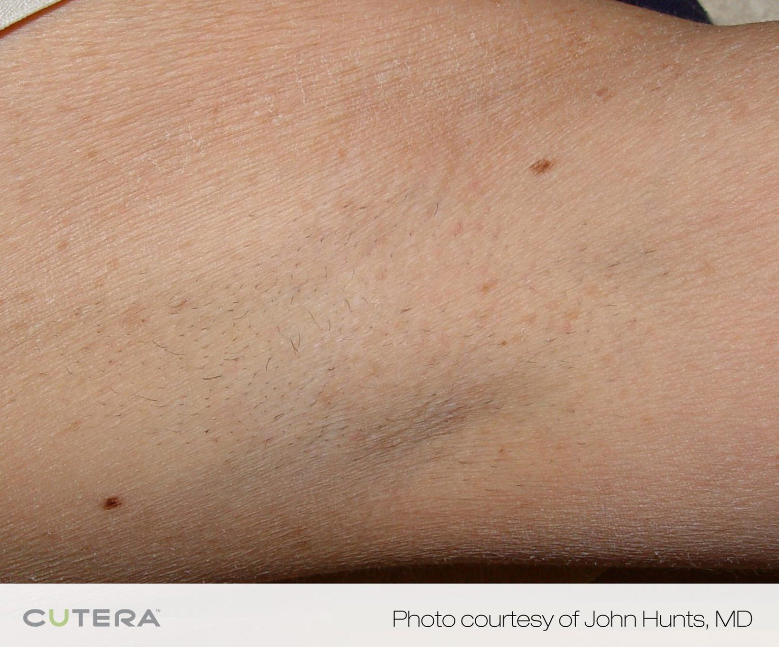 laser hair removal before and after results