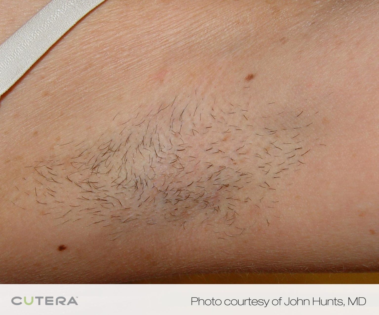 laser hair removal before and after results