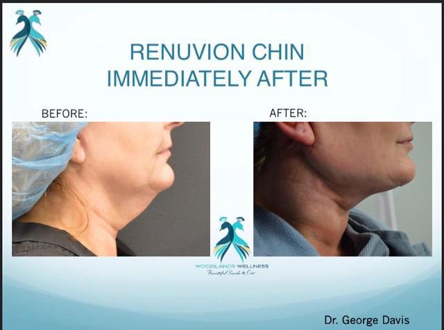 Double Chin Removal Woodlands TX