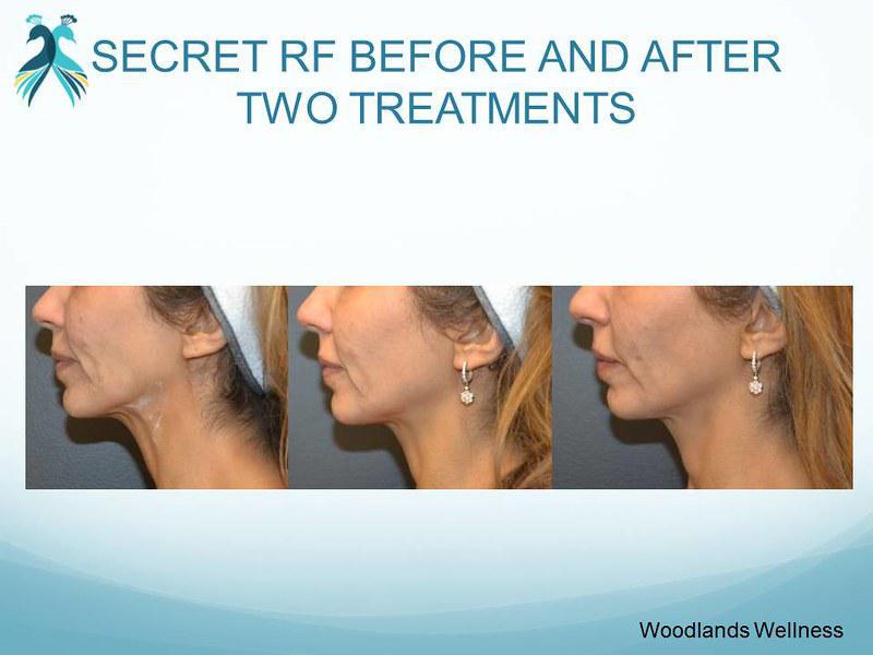 Microneedling RF Woodland TX