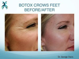 Botox results in Woodlands TX - Before & After pictures