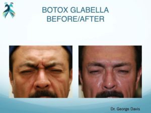 Botox results in Woodlands TX - Before & After pictures
