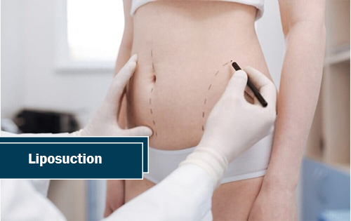 Liposuction Woodlands TX