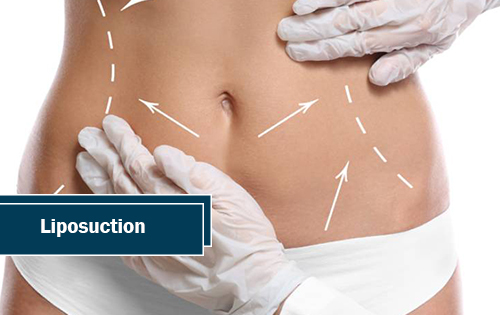 Liposuction Woodlands TX