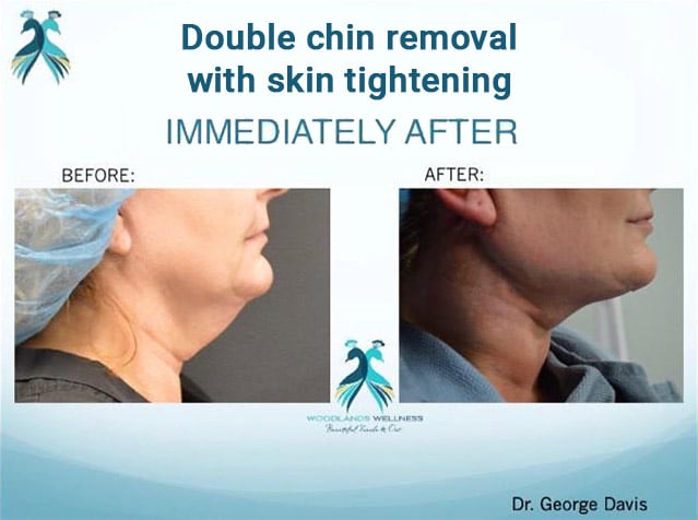 before and after results double chin removal in Woodlands Houston TX