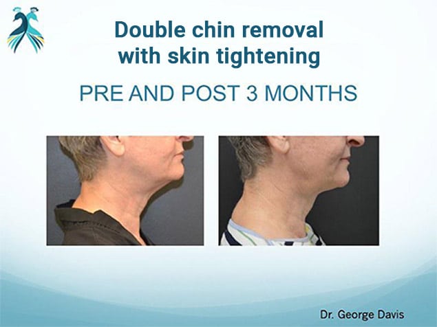 before and after results double chin removal in Woodlands Houston TX