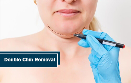 Double Chin Removal Woodlands TX
