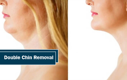 Double Chin Removal Woodlands TX