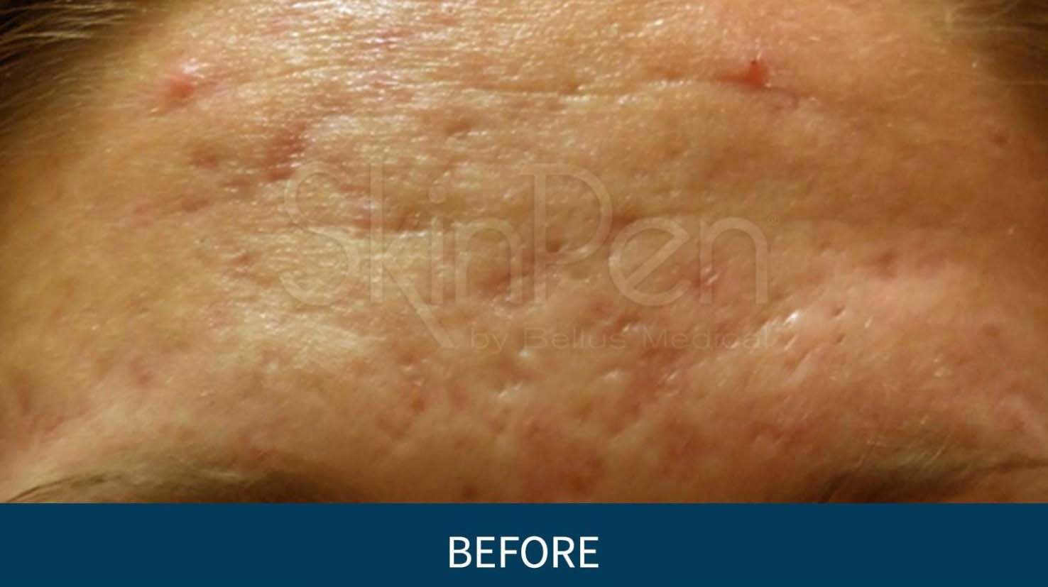 Acne Scar Removal Before & After Results