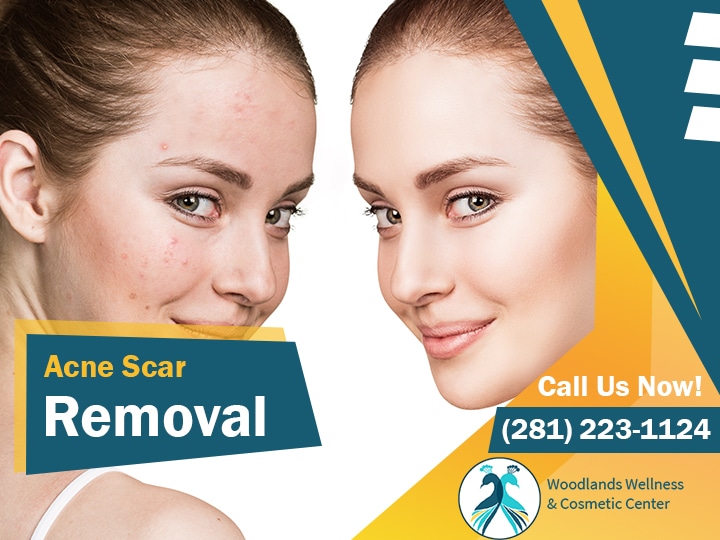 Acne Scar Removal The Woodlands TX