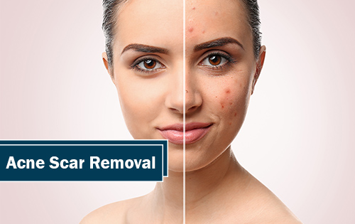 acne scar removal in Woodlands TX