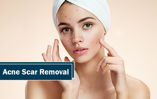 acne scar removal treatment in Woodlands TX