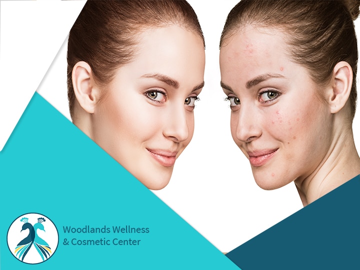 Acne Treatment The Woodlands TX