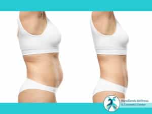 Liposuction Woodlands TX