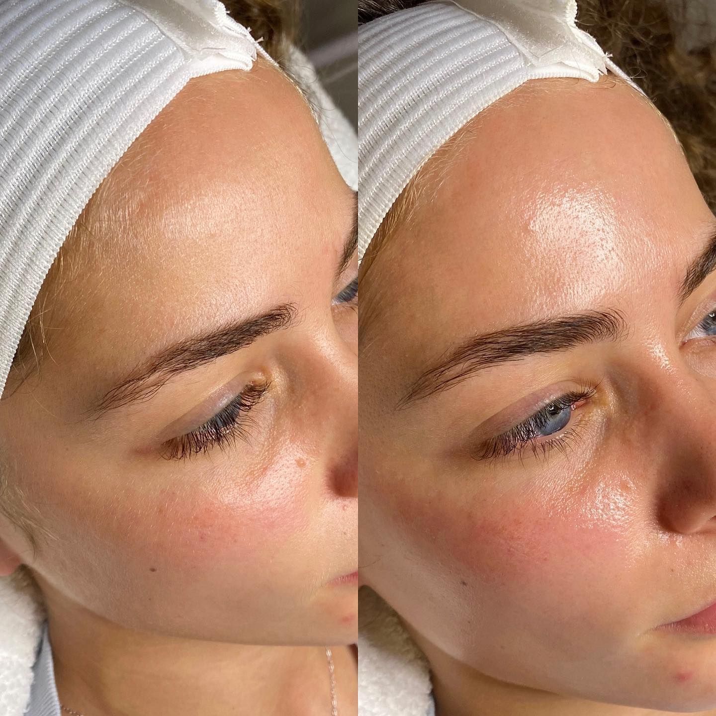 Before and after Dermaplane Facial results