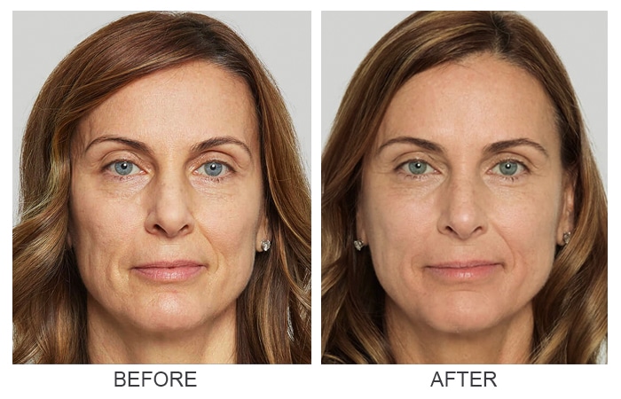 Before and after Sculptra results