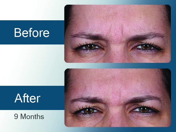 Before and after DAXXIFY results