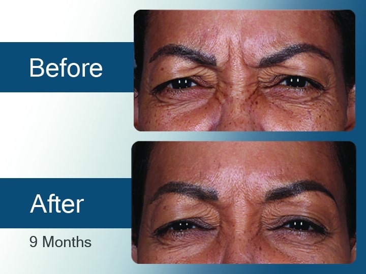 Before and after DAXXIFY results