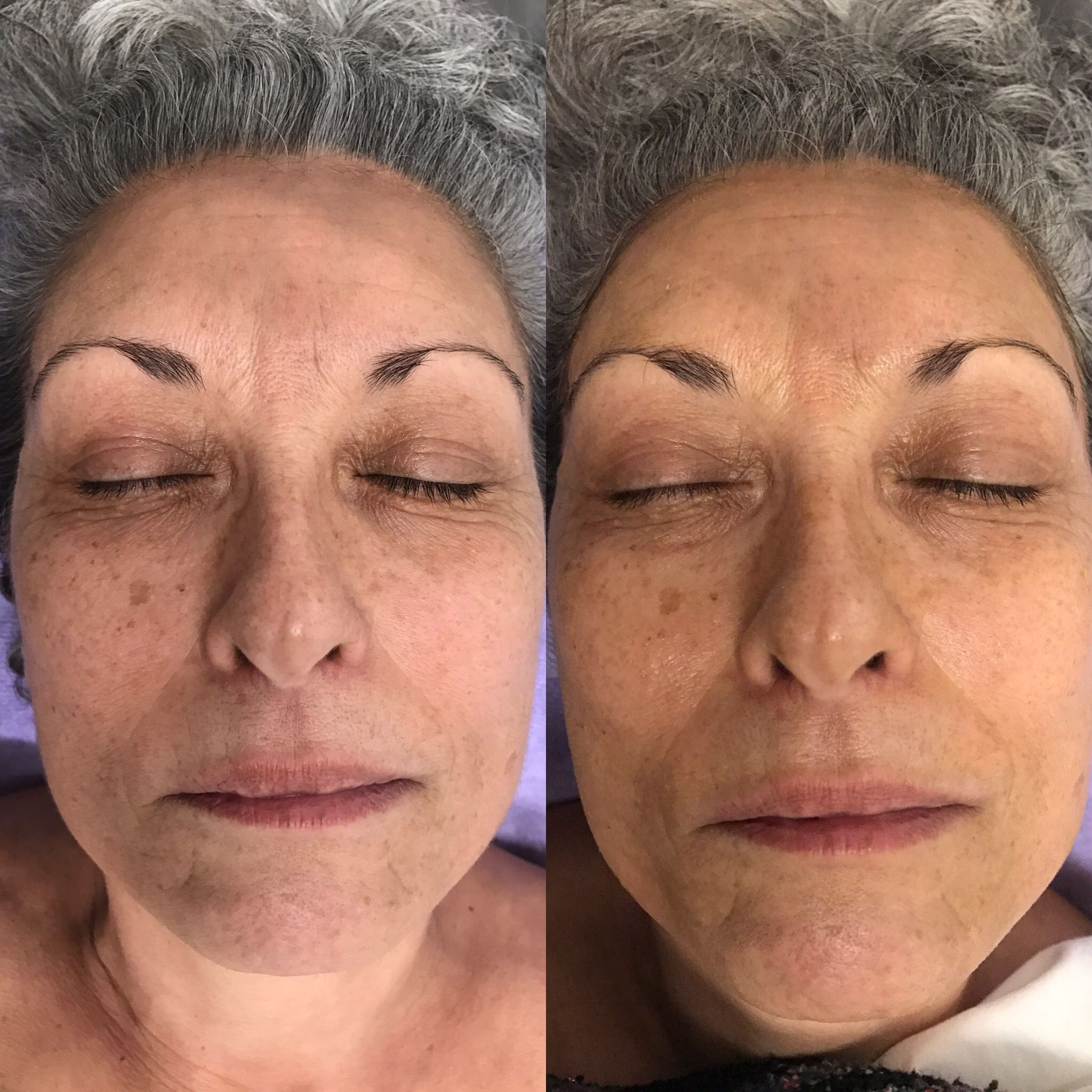 Before and after Dermaplane Facial results
