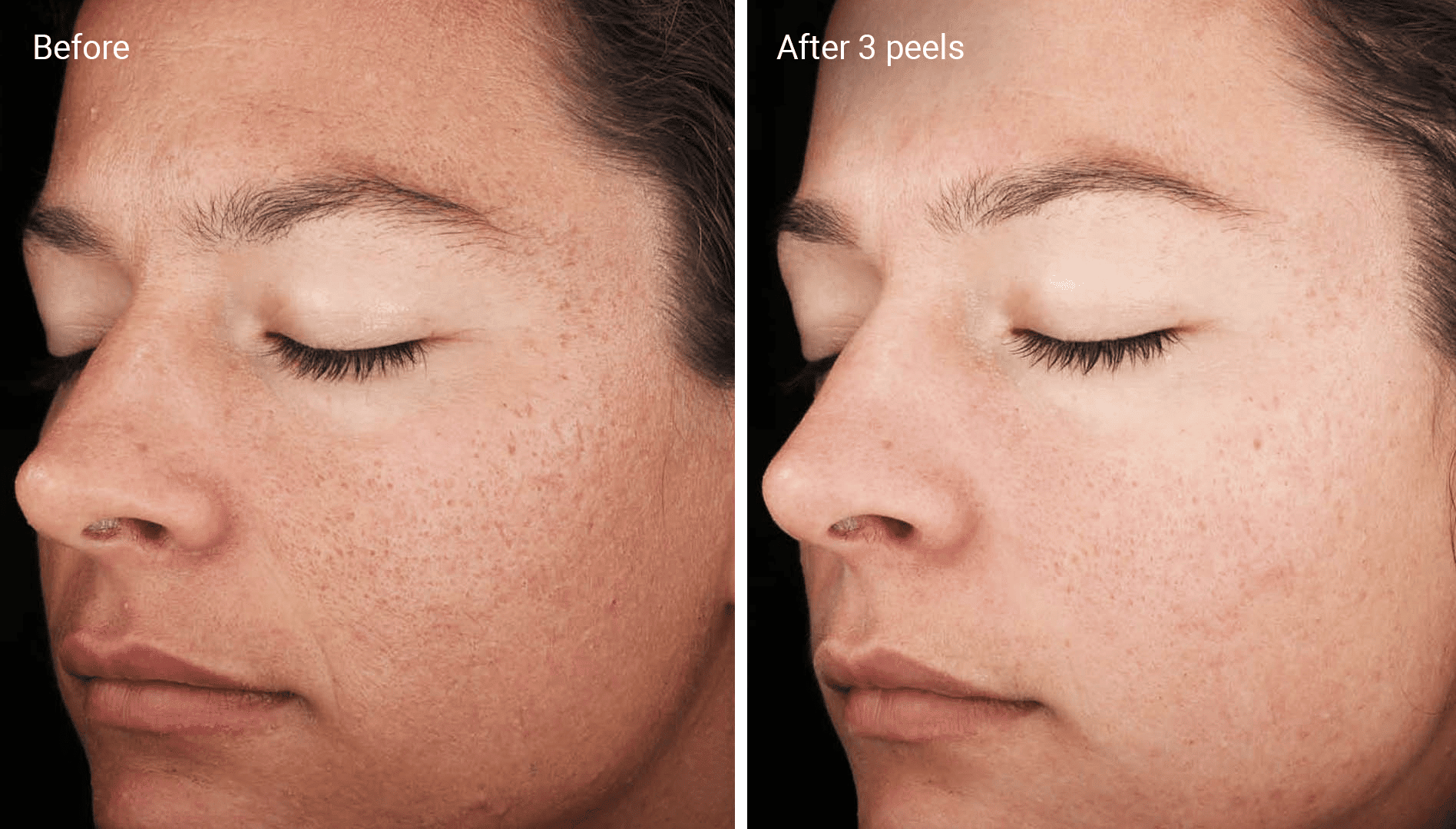 Before and after chemical peel results