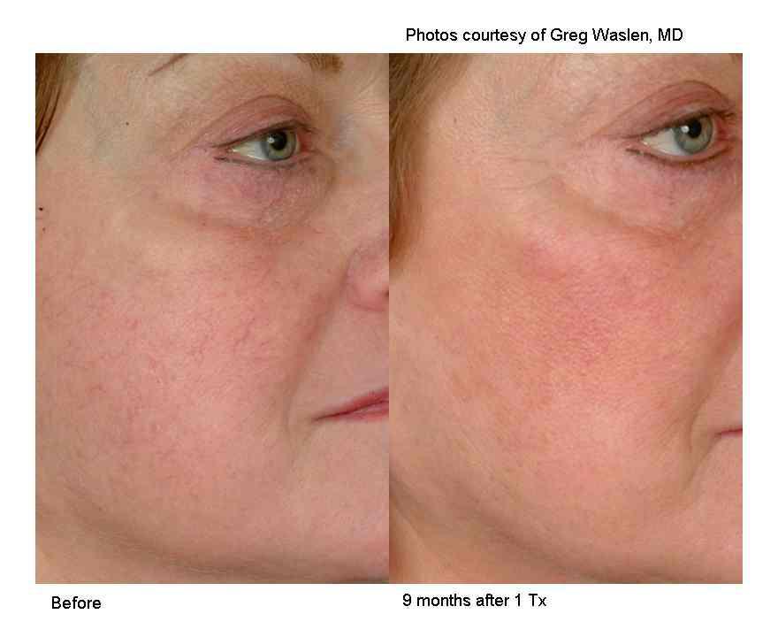 Before and after laser vein results